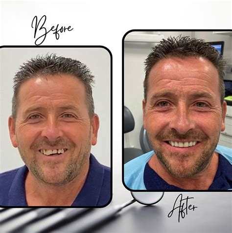 bridge implant in ashford|Your Local Ashford Dentist & Implant Clinic in Barnet .